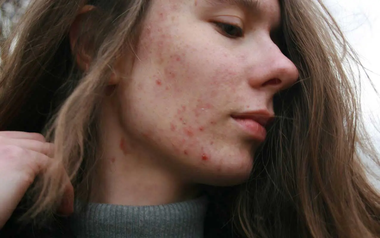 Is Severe Acne Genetic?